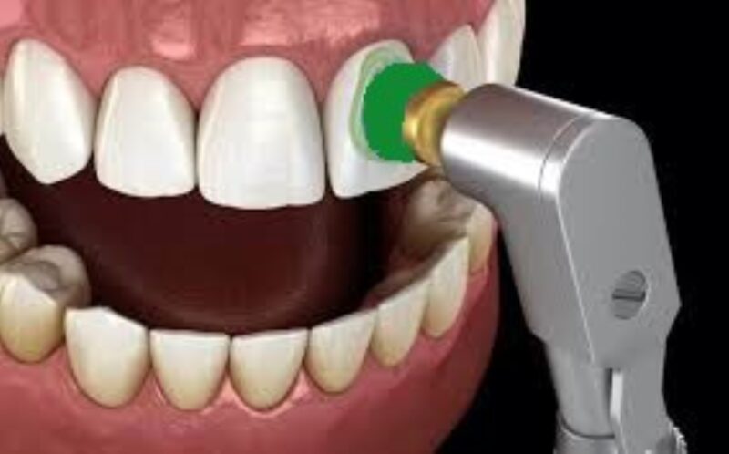 EZ Dental Prophy Cups – Green, 100 pcs - Image 4